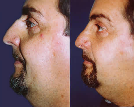 Broken Nose by Dr jason Diamond reviews - broken-nose-dr-jason-diamond-reviews