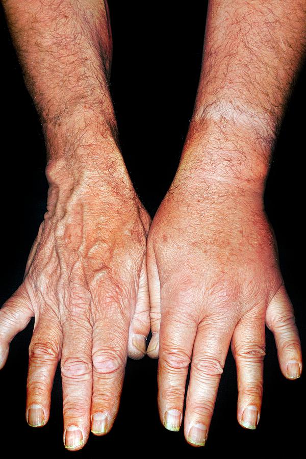 Allergic Reaction To Wasp Sting Photograph By Dr P Marazzi Science