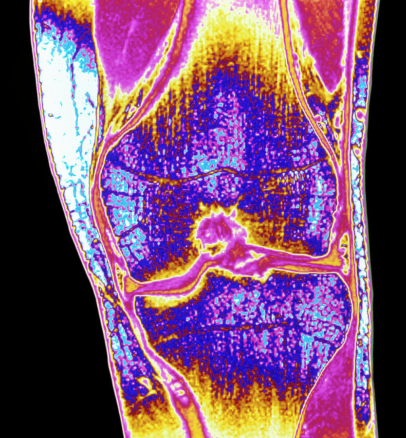 Coloured Mri Of A Section Through A Knee Joint Photograph By Simon