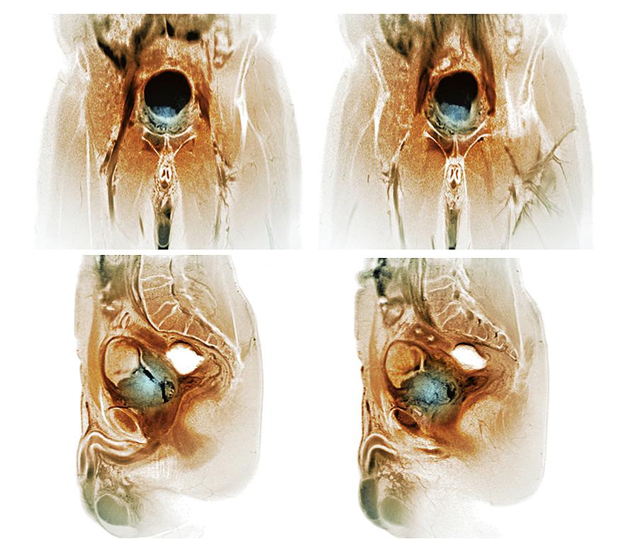 Metastatic Bladder Cancer By Zephyr