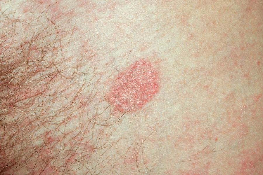 Pityriasis Rosea Photograph By Dr P Marazzi Science Photo Library