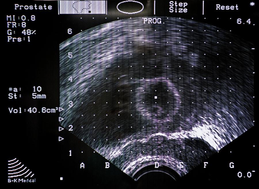 Prostate Cancer Radiotherapy Scan Photograph By Antonia Reeve Science Photo Library Pixels