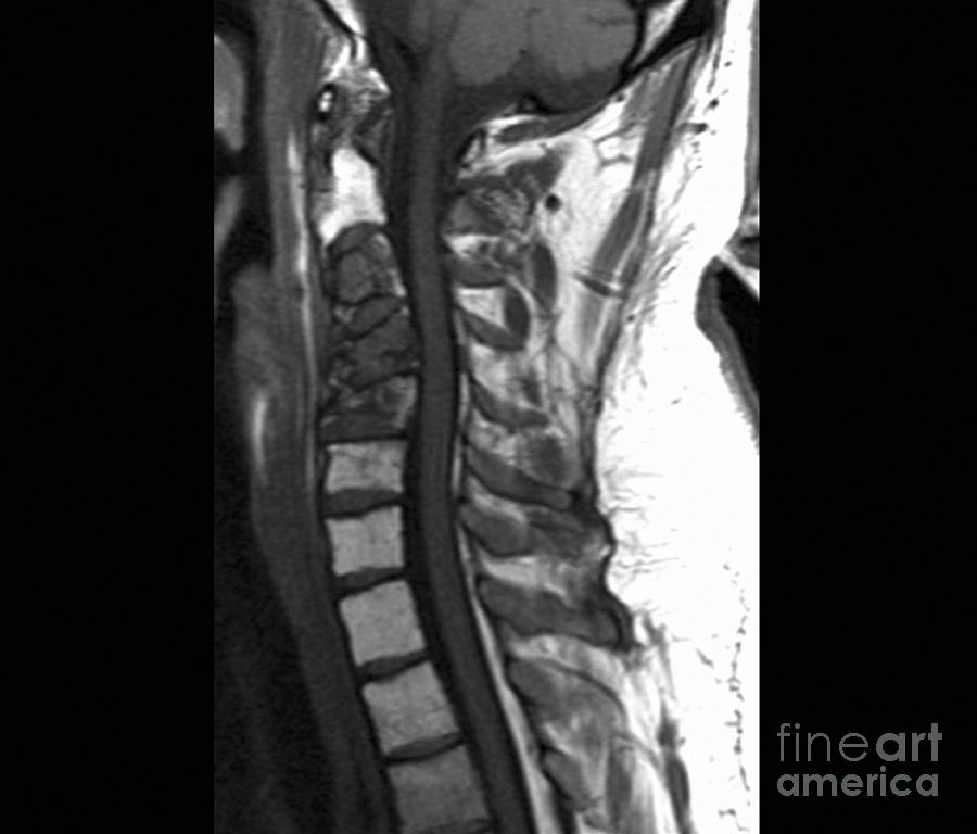 Spinal Cancer Mri Scan 1 By Zephyr