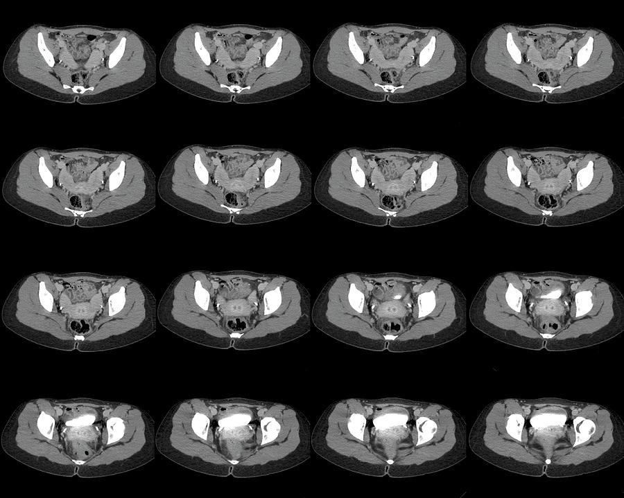 Two Horned Uterus Photograph By Zephyr Science Photo Library Pixels