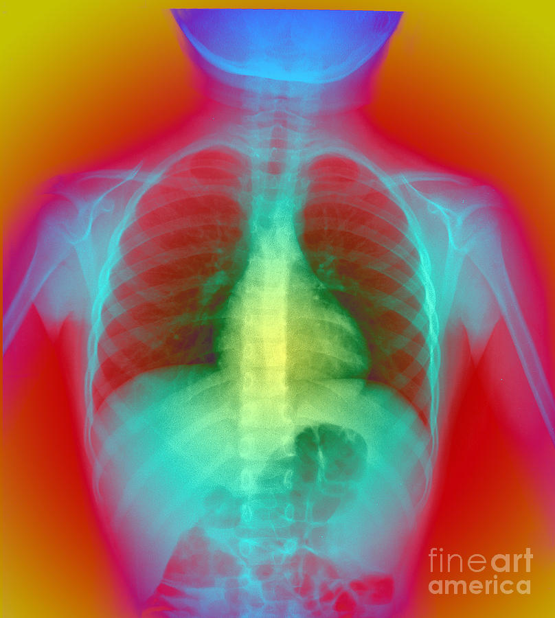 X Ray Of Chest Photograph By Scott Camazine Fine Art America