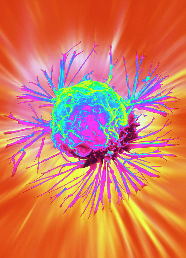 Coloured Sem Of A Breast Cancer Cell Photograph By Nci Science Photo