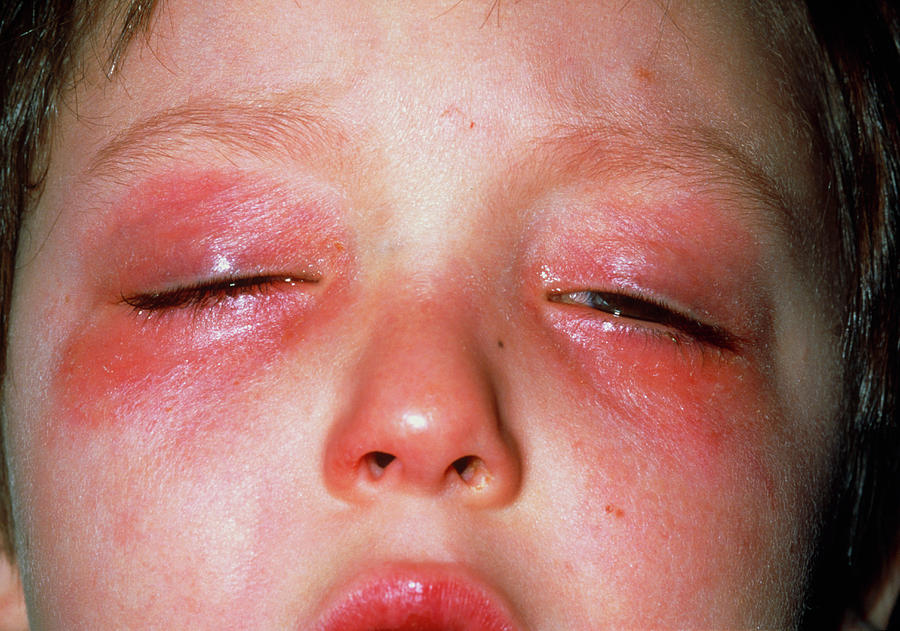 Allergic Conjunctivitis Photograph By Dr P Marazzi Science Photo Library