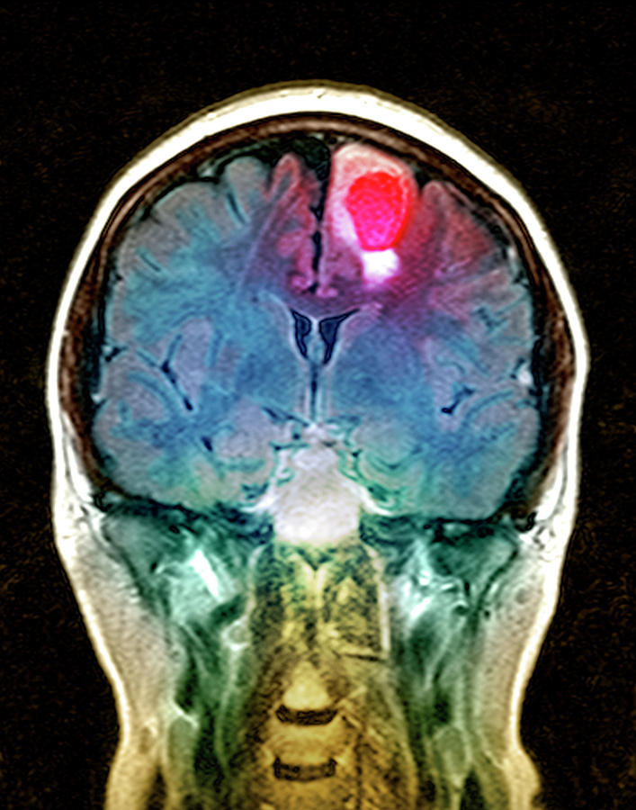 Brain Tumour By Simon Fraser Science Photo Library