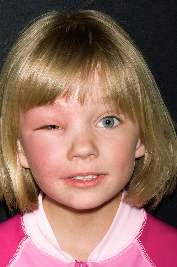 Allergic Reaction Photograph By Dr P Marazzi Science Photo Library