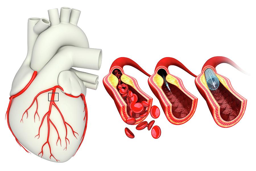 Coronary Angioplasty Stent Insertion Photograph By Pixologicstudio