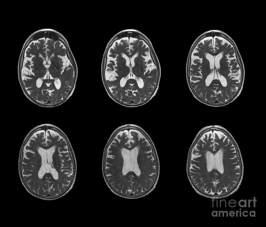 Early Onset Alzheimer S Disease Mri Scan Photograph By Zephyr Pixels