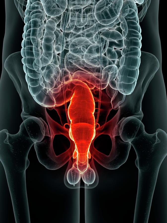 Inflamed Rectum Photograph By Sciepro Pixels