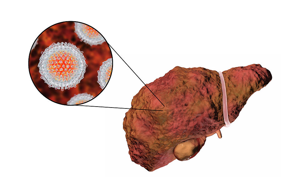 Liver Cirrhosis Due To Hepatitis C Photograph By Kateryna Kon Science