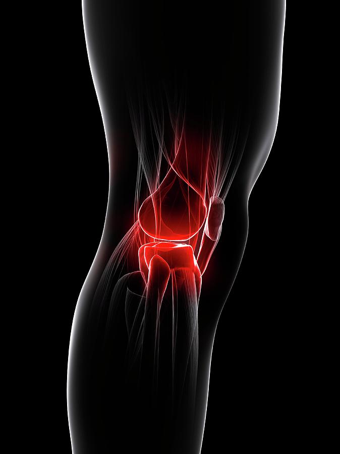 Knee Pain 25 By Sciepro Science Photo Library