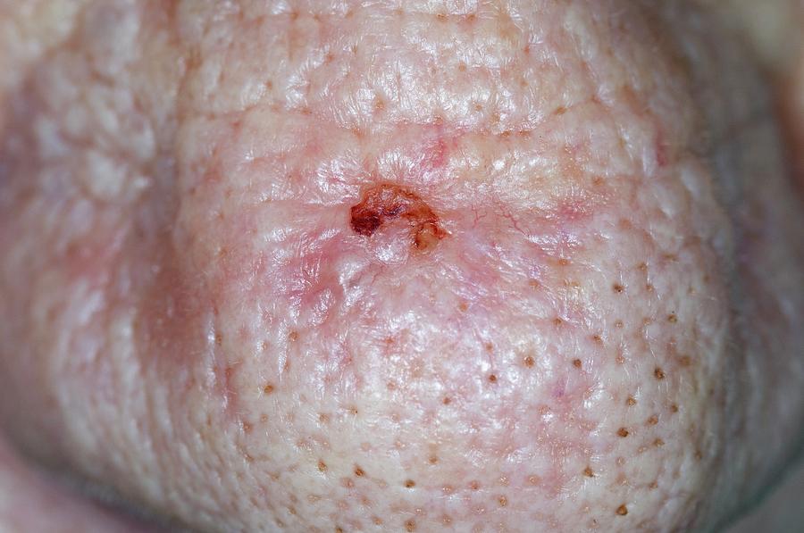 Basal Cell Skin Cancer On The Nose Photograph By Dr P Marazzi Science