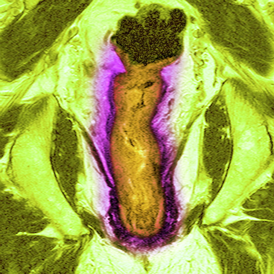 Bowel Cancer Photograph By Simon Fraser Science Photo Library Fine