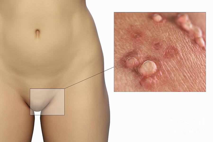 Male Herpes Symptoms: Do you have Male Genital Herpes?