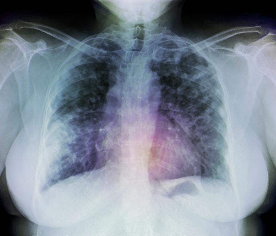 Lung Disease Photograph By Zephyr Science Photo Library Pixels