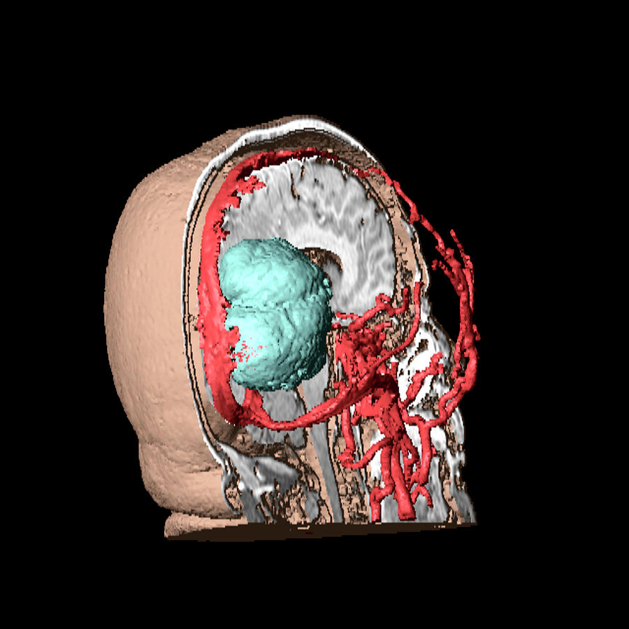 Brain Tumour Photograph By Simon Fraser Science Photo Library Pixels