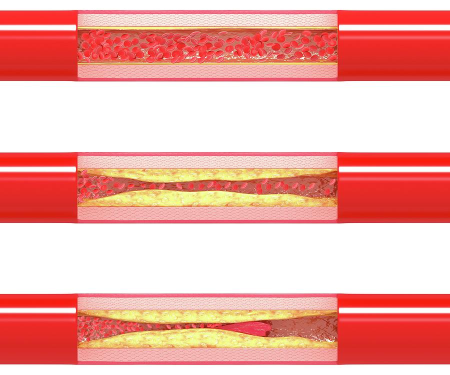 Atherosclerosis Photograph By Pixologicstudio Science Photo Library