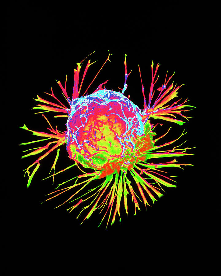 Coloured Sem Of A Breast Cancer Cell Photograph By Nci Science Photo