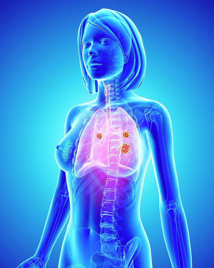 Female Lung Cancer Photograph By Pixologicstudio Science Photo Library