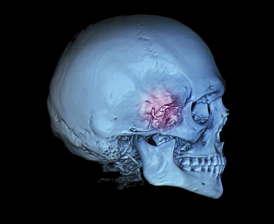 Human Skull And Site Of Pituitary Gland Photograph By Zephyr Science