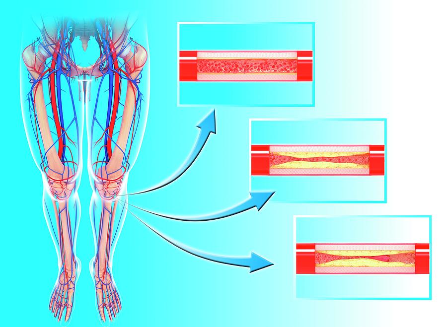 Atherosclerosis Photograph By Pixologicstudio Science Photo Library