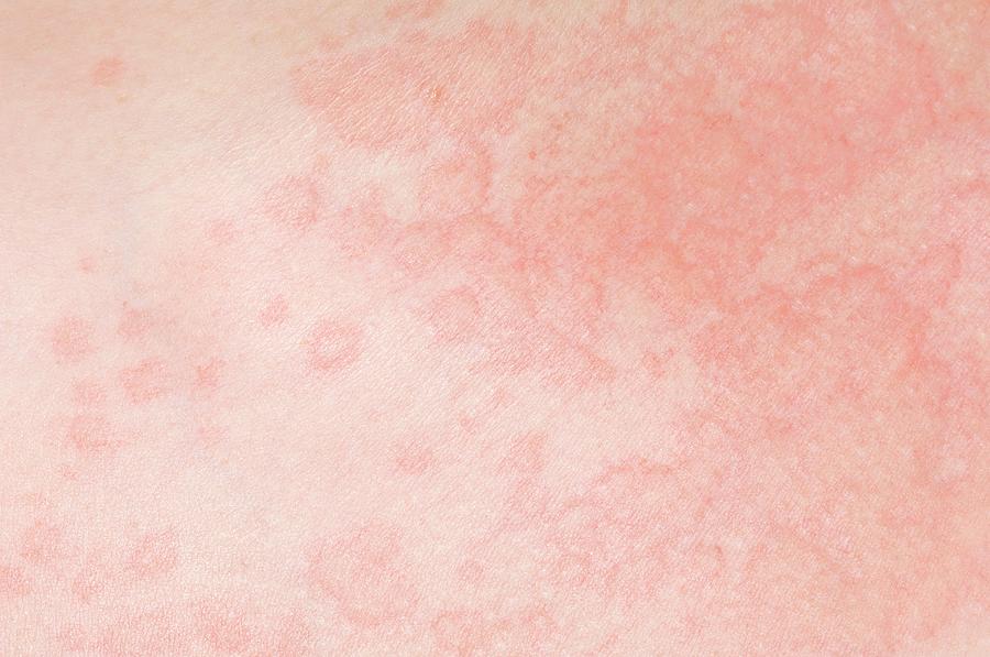 Urticaria Rash Photograph By Dr P Marazzi Science Photo Library