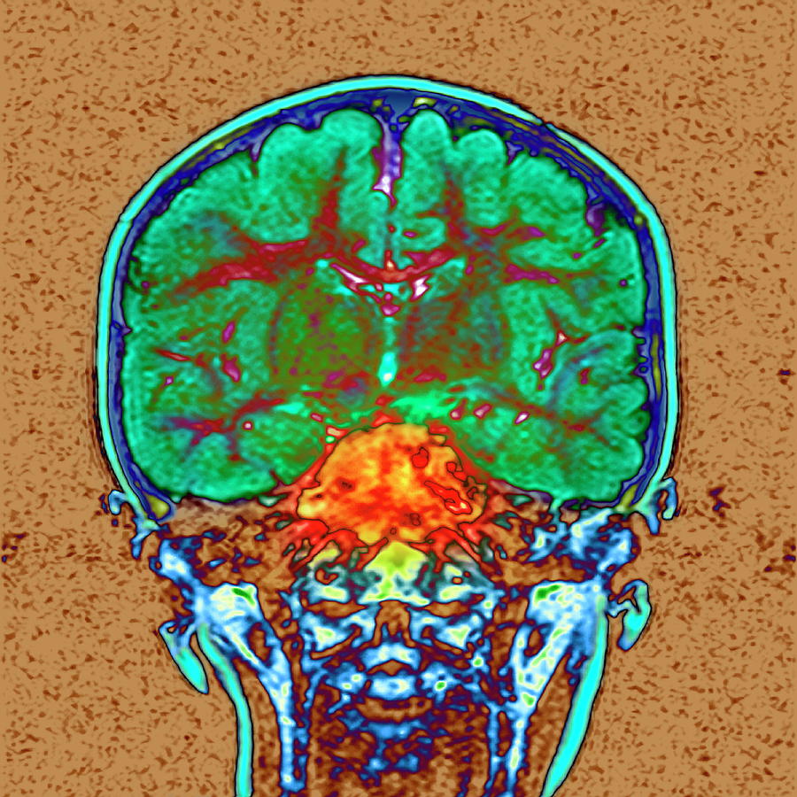 Brain Cancer 6 By Simon Fraser Newcastle Hospitals Nhs Trust Science