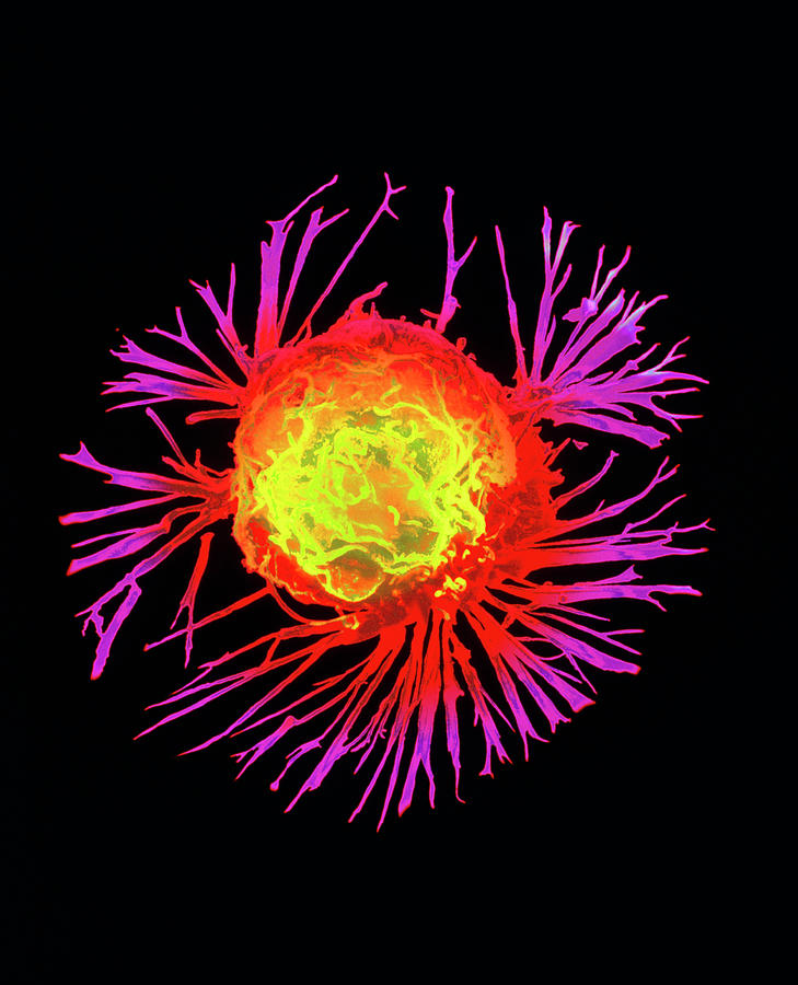 Coloured Sem Of A Breast Cancer Cell 7 By Nci Science Photo Library