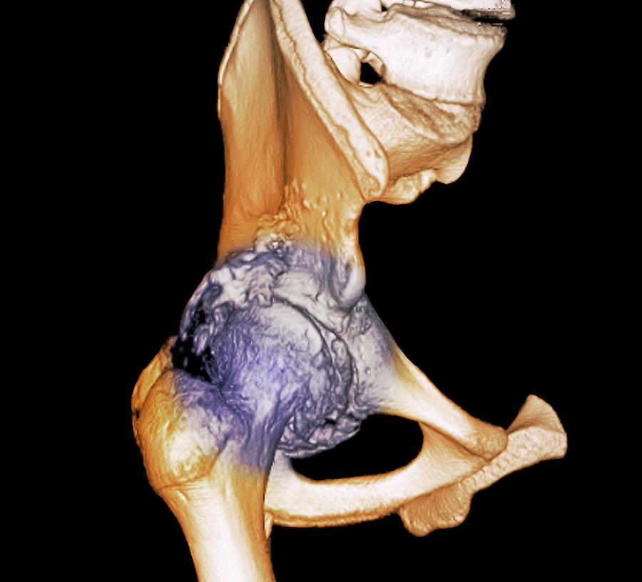 Osteoarthritis Of The Hip Photograph By Zephyr Science Photo Library