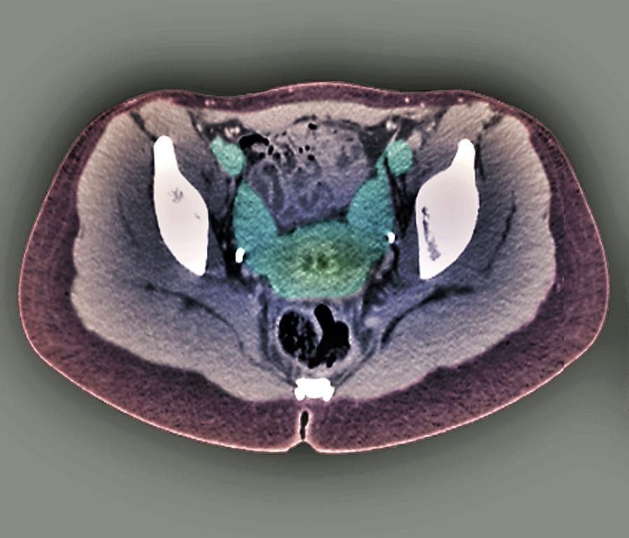 Two Horned Uterus 7 By Zephyr Science Photo Library