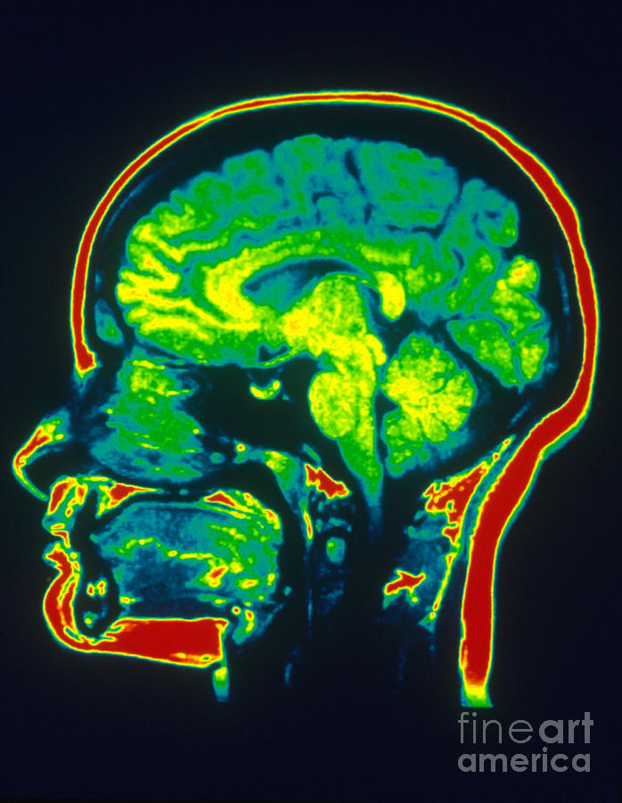 Mri Of Brain Photograph By Scott Camazine Pixels