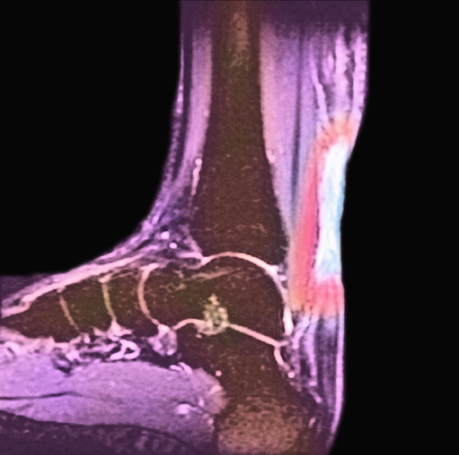 Achilles Tendon Injury X Ray Photograph By Science Stock Photography