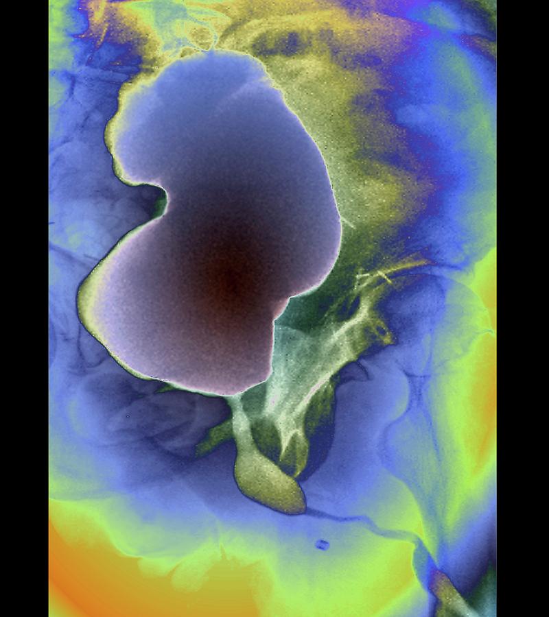 Augmented Bladder Photograph By Zephyr Science Photo Library Pixels