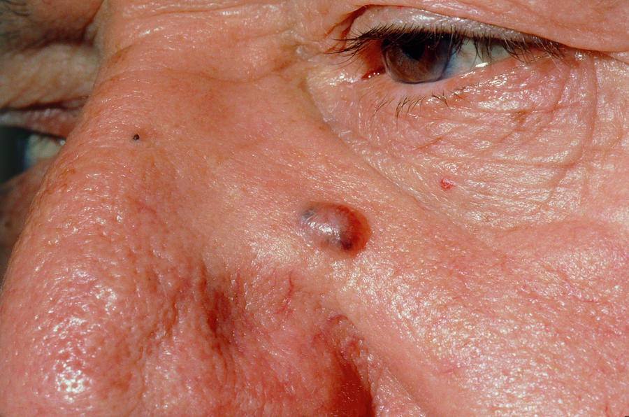 Basal Cell Cancer Beneath Elderly Man S Eye Photograph By Dr P Marazzi Science Photo Library