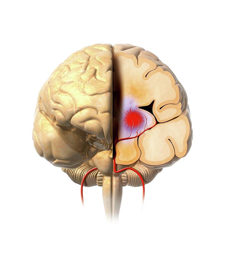 Brain Haemorrhage Photograph By Claus Lunau Pixels