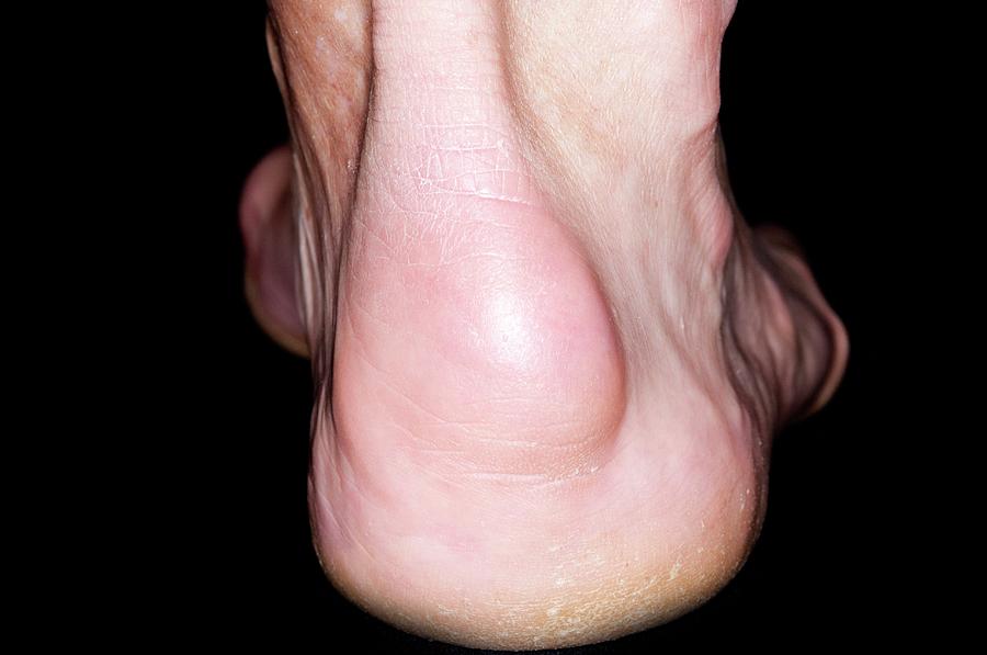 Bursitis Of The Heel Of The Foot Photograph By Dr P Marazzi Science Photo Library