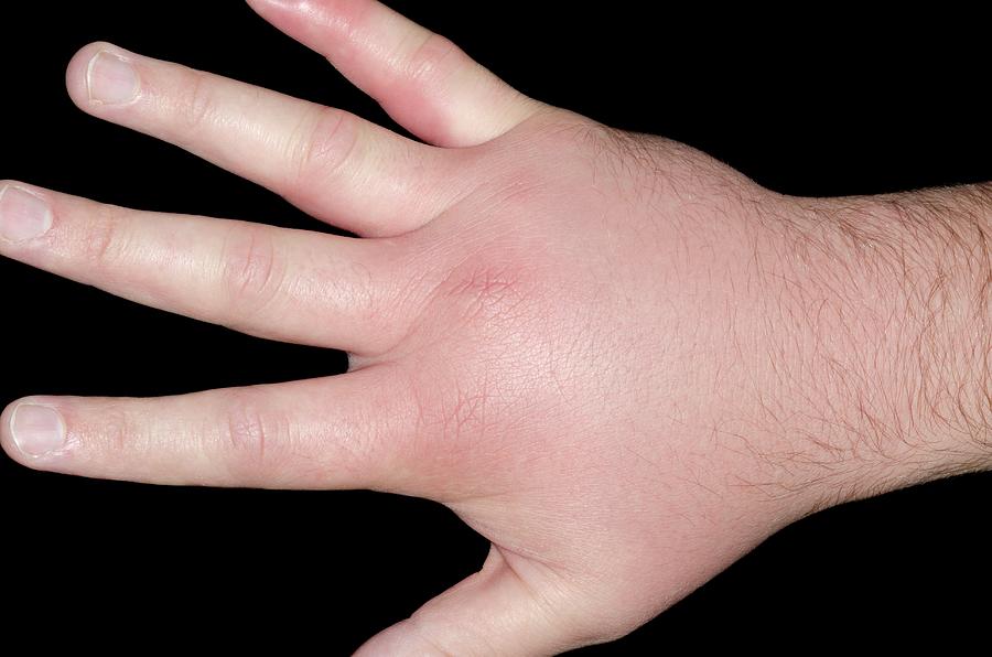 Cellulitis Of The Hand Photograph By Dr P Marazzi Science Photo Library