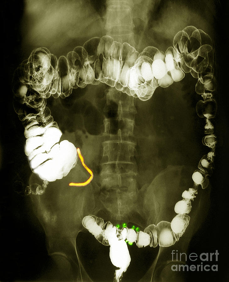 Colon X Ray With Barium Contrast Photograph By Scott Camazine Fine