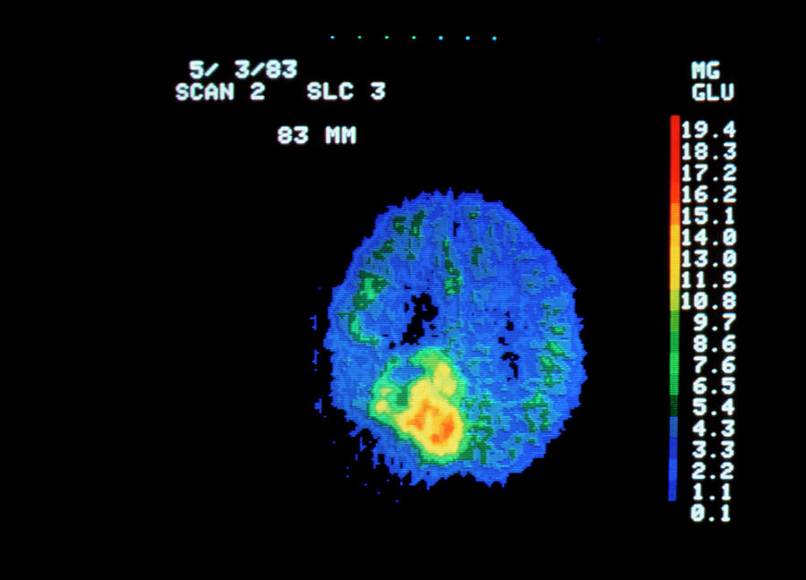 Coloured Pet Scan Of Brain Containing A Tumour Photograph By National