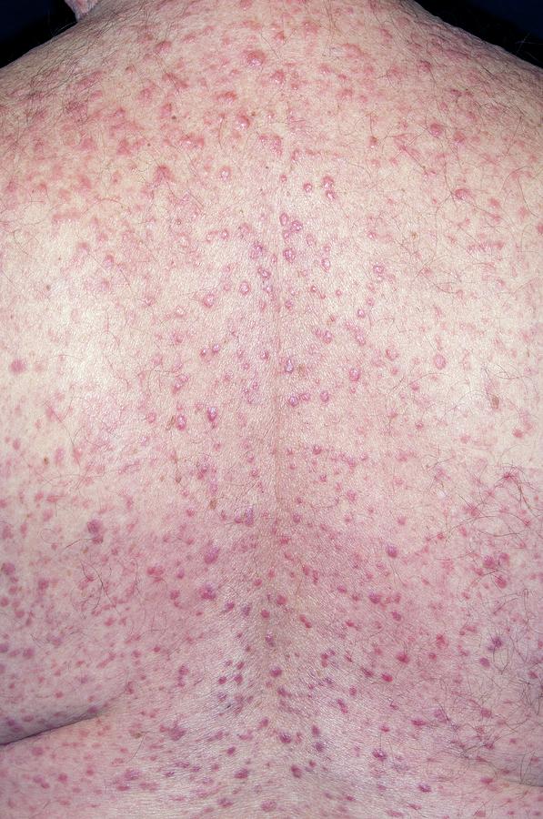 Eczema On The Back Photograph By Dr P Marazzi Science Photo Library