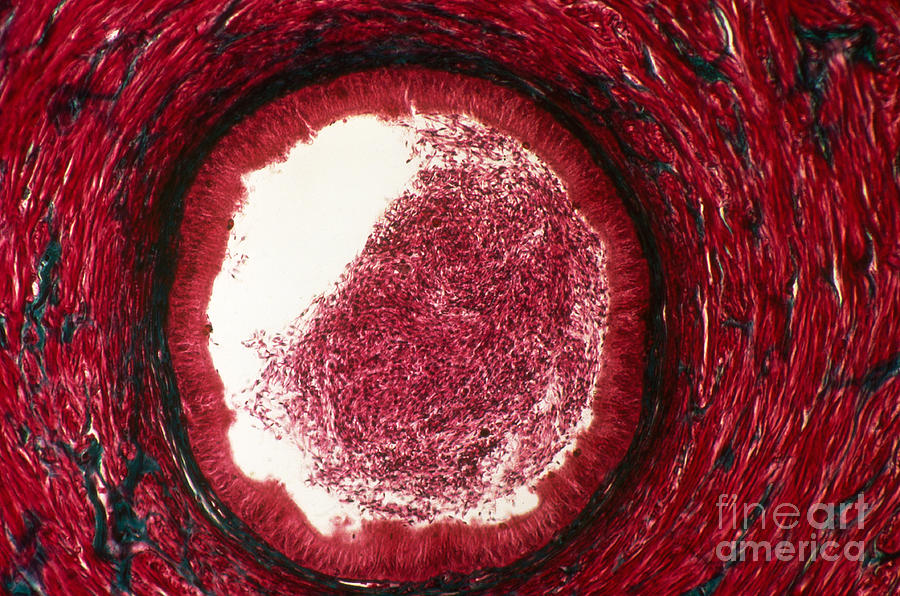 Epididymis With Sperm Photograph By David M Phillips