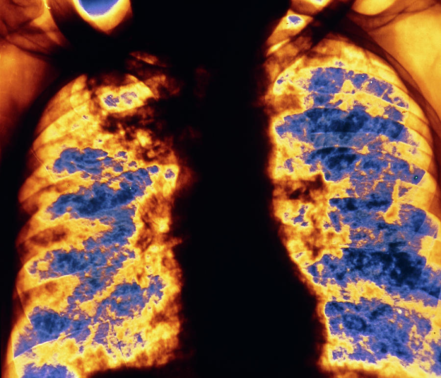 F Col Chest X Ray Of Silicosis Photograph By Alain Pol Ism Science