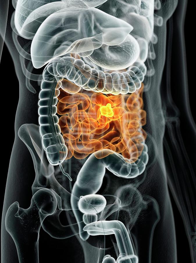 Human Bowel Cancer Photograph By Sciepro Pixels