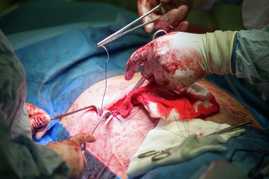 Intestinal Surgery Photograph By Mark Thomas Science Photo Library Pixels