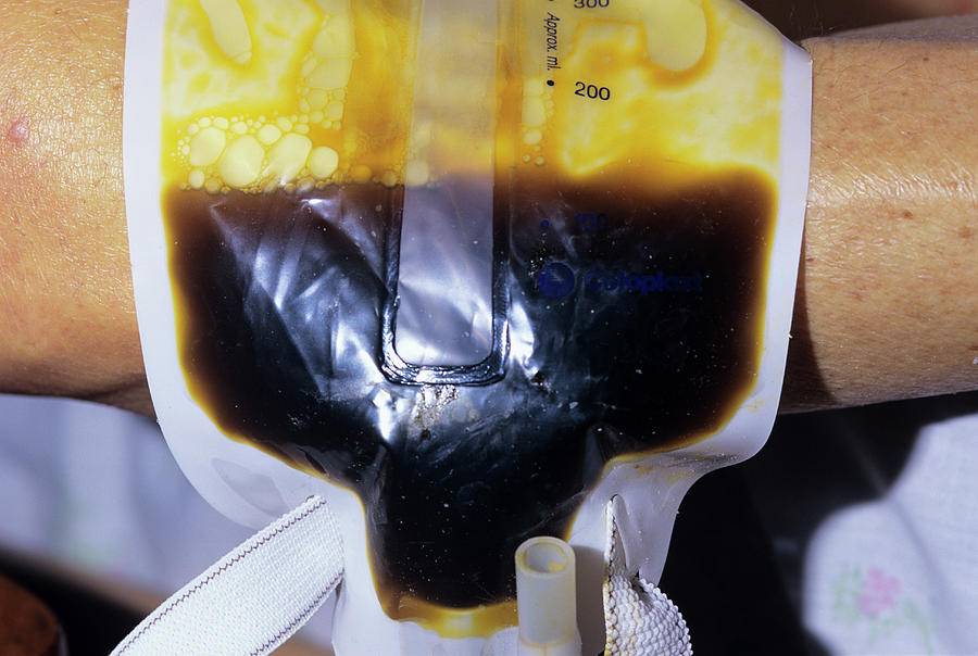 Jaundiced Urine And Skin Due To Cancer Photograph By Dr P Marazzi