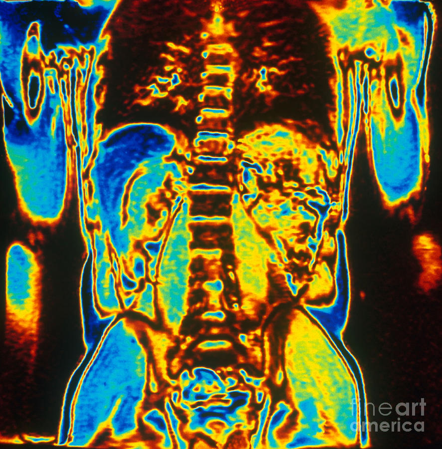 Mri Of Human Torso Photograph By Scott Camazine Fine Art America