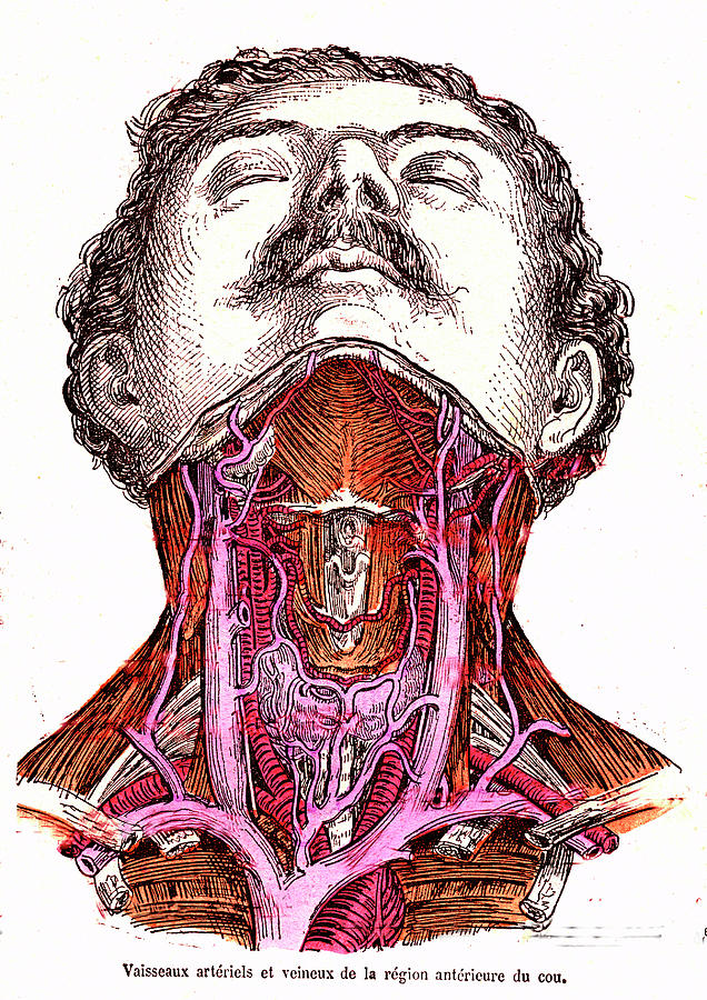 Neck Blood Vessels Photograph By Collection Abecasis Science Photo